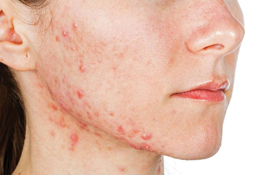 7 dấu hiệu nhận biết khi bạn bị kích ứng với sản phẩm skincare | Mỹ phẩm Caryophy