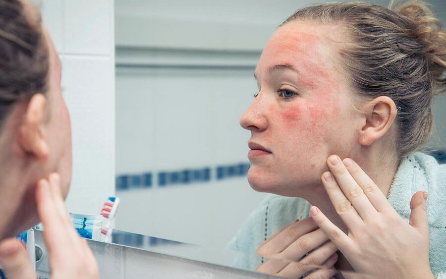 7 dấu hiệu nhận biết khi bạn bị kích ứng với sản phẩm skincare | Mỹ phẩm Caryophy