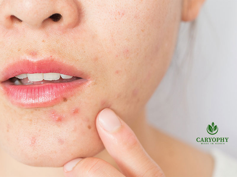 Mụn viêm thường do vi khuẩn P. acnes gây ra