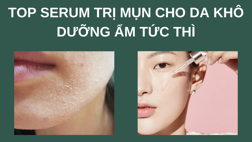 Điểm mặt top 5 serum trị mụn cho da khô dưỡng ẩm tức thì giá bình dân - Mỹ Phẩm Caryophy Việt Nam
